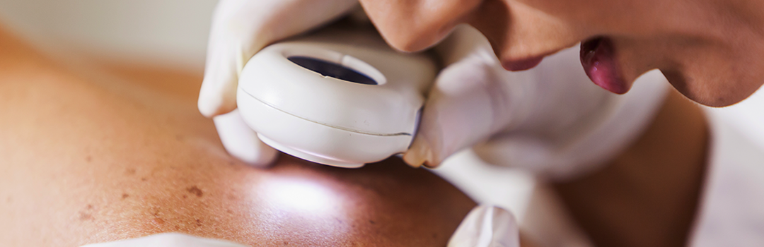 Lunares y cáncer de piel: Aprende a identificar cuándo son peligrosos